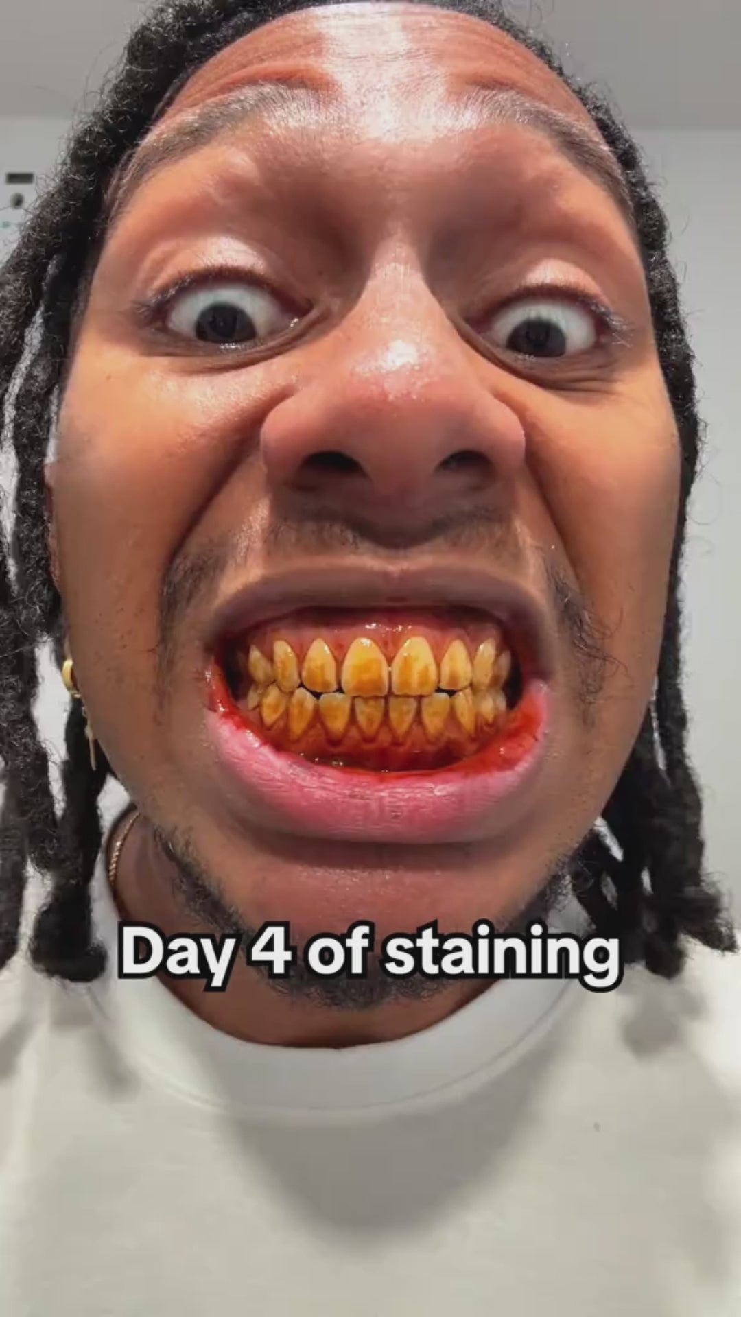 Hismile V34 Whitening Strips, Teeth Whitening Strips, Purple Tooth Whitening, Tooth Stain Treatment, Combining Whitening and Colour Correction video